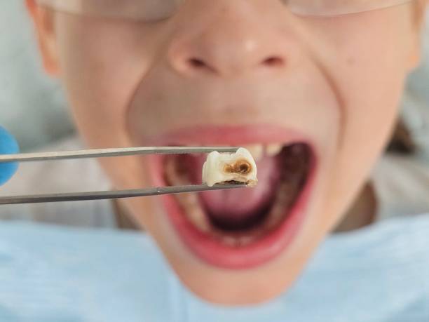 Best Emergency Dental Extractions in Elk Grove Vlage, IL